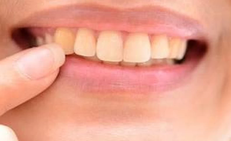 علامت دندانی که مینای آن خراب شده