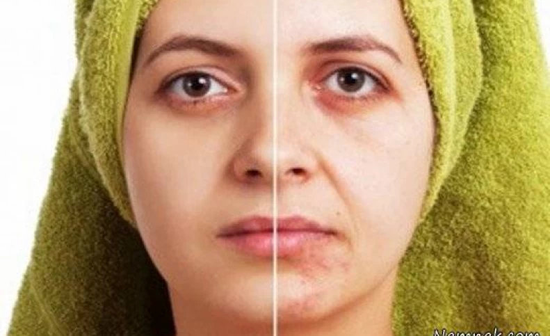 تیره ترین لک صورت را با آب پیاز درمان کنید + ماسک