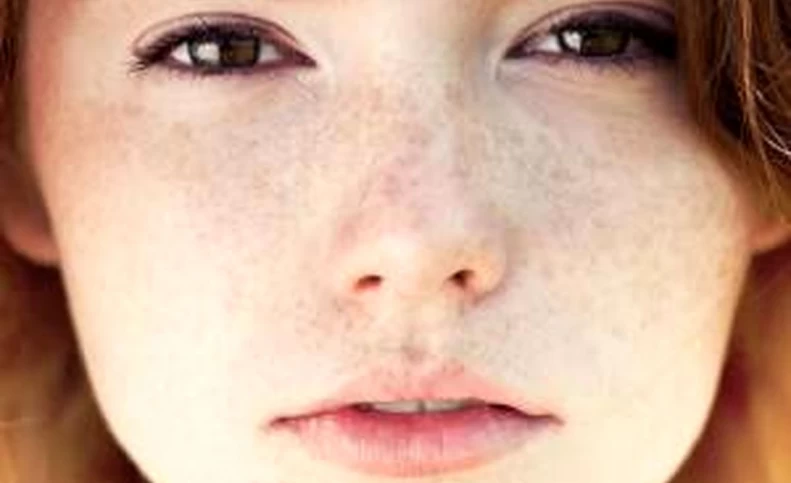 درمان لک قهوه ای پوست با ضد لک های گیاهی و خانگی