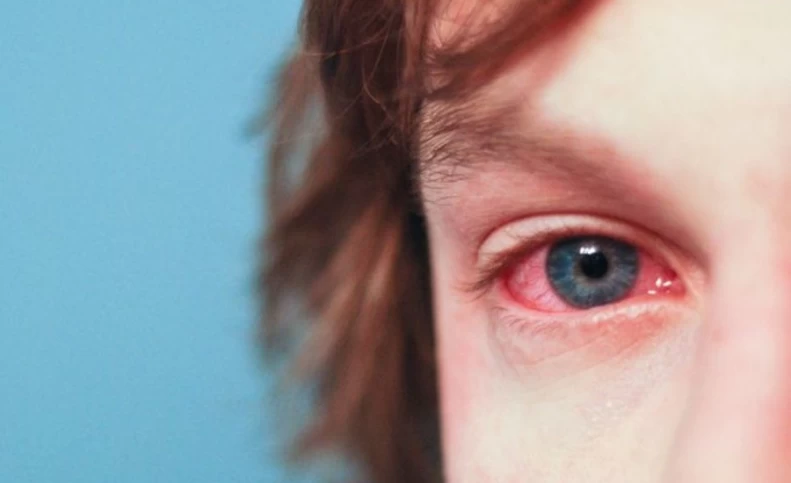 همه چیز درمورد آلرژی چشم؛ علائم و درمان