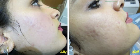 روش از بین بردن جای جوش از بین بردن قرمزی جای جوش صورت, از بین بردن جای جوش با لیزر, راه های از بین بردن جای جوش